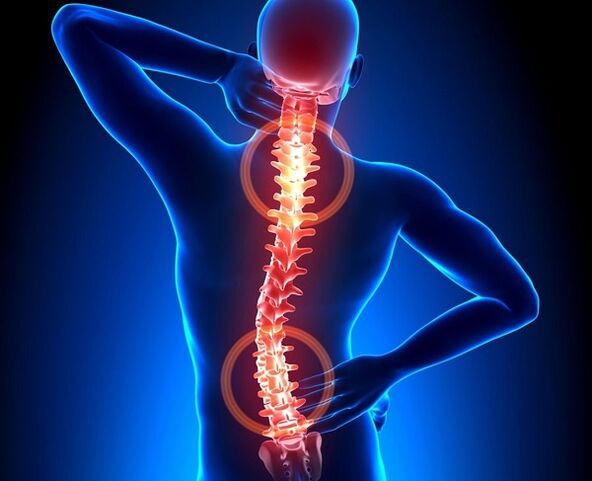 bolečine v hrbtenici z osteohondrozo