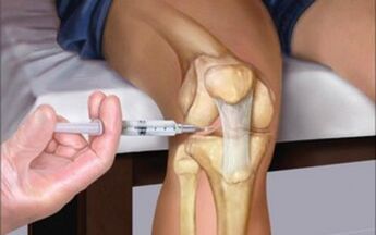intraartikularna injekcija v sklep zaradi artroze