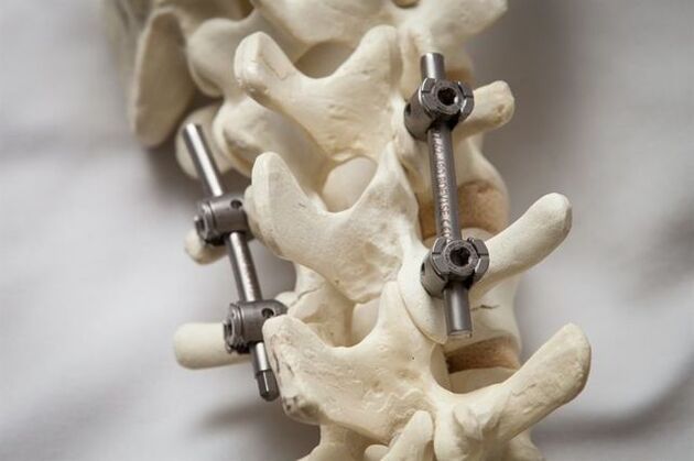 fiksacija hrbtenice osteohondroza vratu