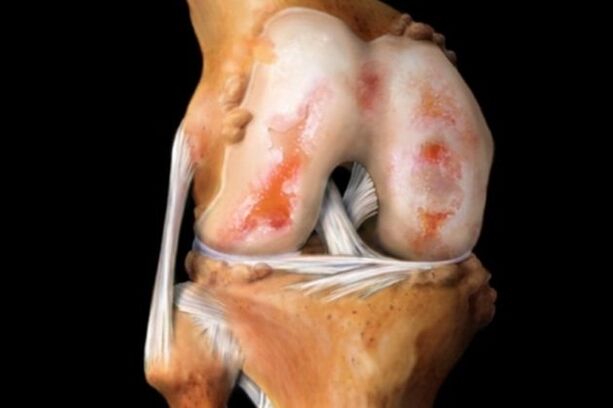 poškodbe hrustanca pri artrozi kolena