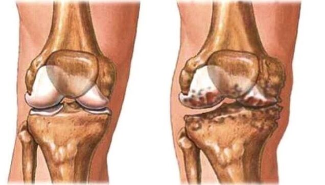 zdrava artroza kolena in kolena