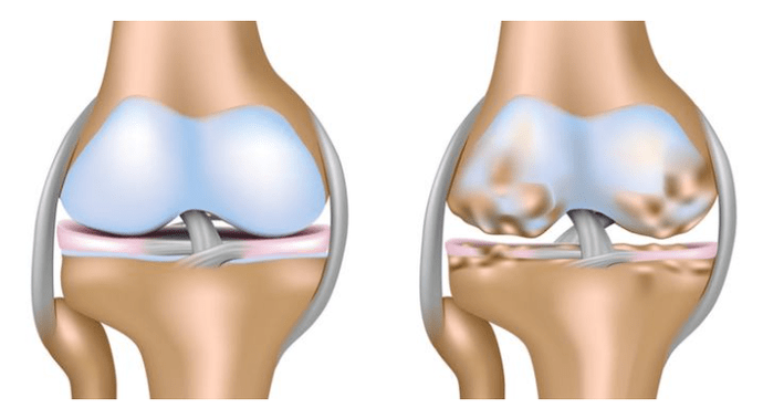 zdravega hrustanca in poškodbe kolenskega sklepa z artrozo
