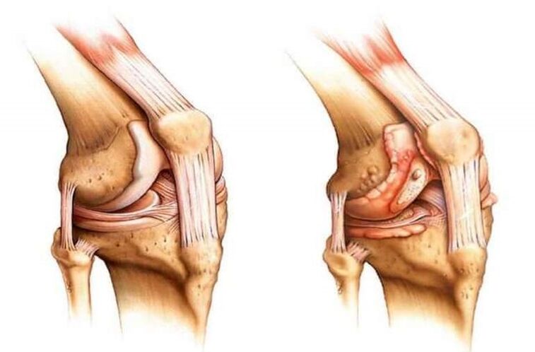 zdravo koleno in artroza kolenskega sklepa