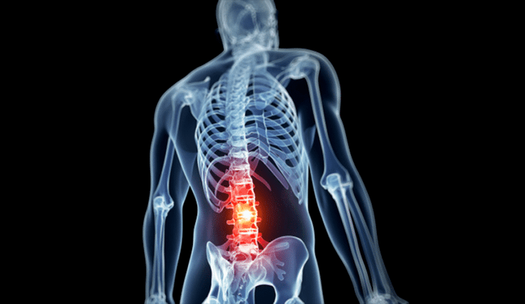 lezija ledvene hrbtenice pri osteohondrozi