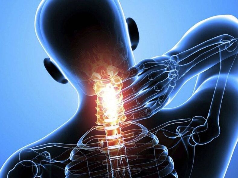 Osteohondrozo vratne hrbtenice spremlja bolečina v vratu
