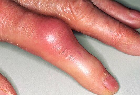 Protin spremljajo ostre bolečine v prstih in otekanje sklepov. 