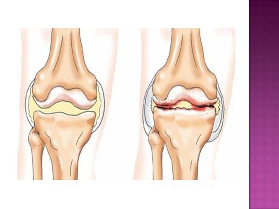 Sklep je normalen (levo) in prizadet zaradi osteoartritisa (desno)