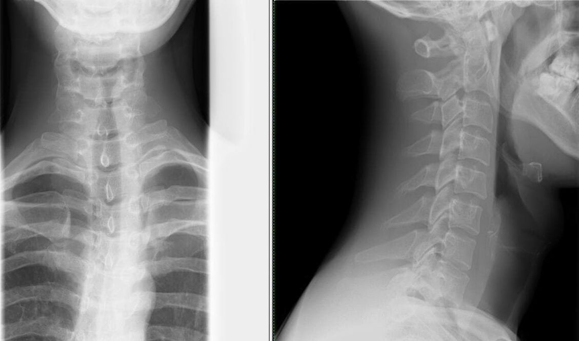 Rentgen hrbtenice je preprosta in učinkovita metoda za diagnosticiranje osteohondroze
