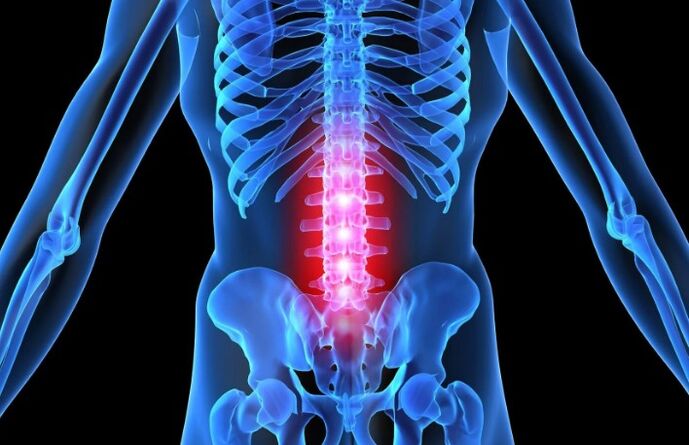 Osteohondroza ledvenega območja