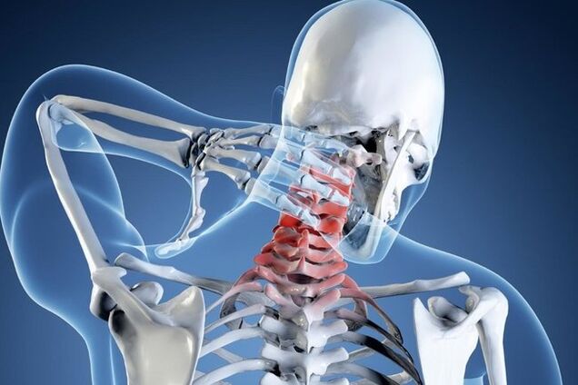 osteohondroza vratne hrbtenice